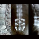 SURF NEWS THE STRAW THAT BROKE THE SURFER'S BACK